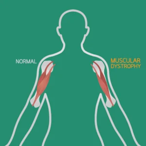 Muscular Dystrophy