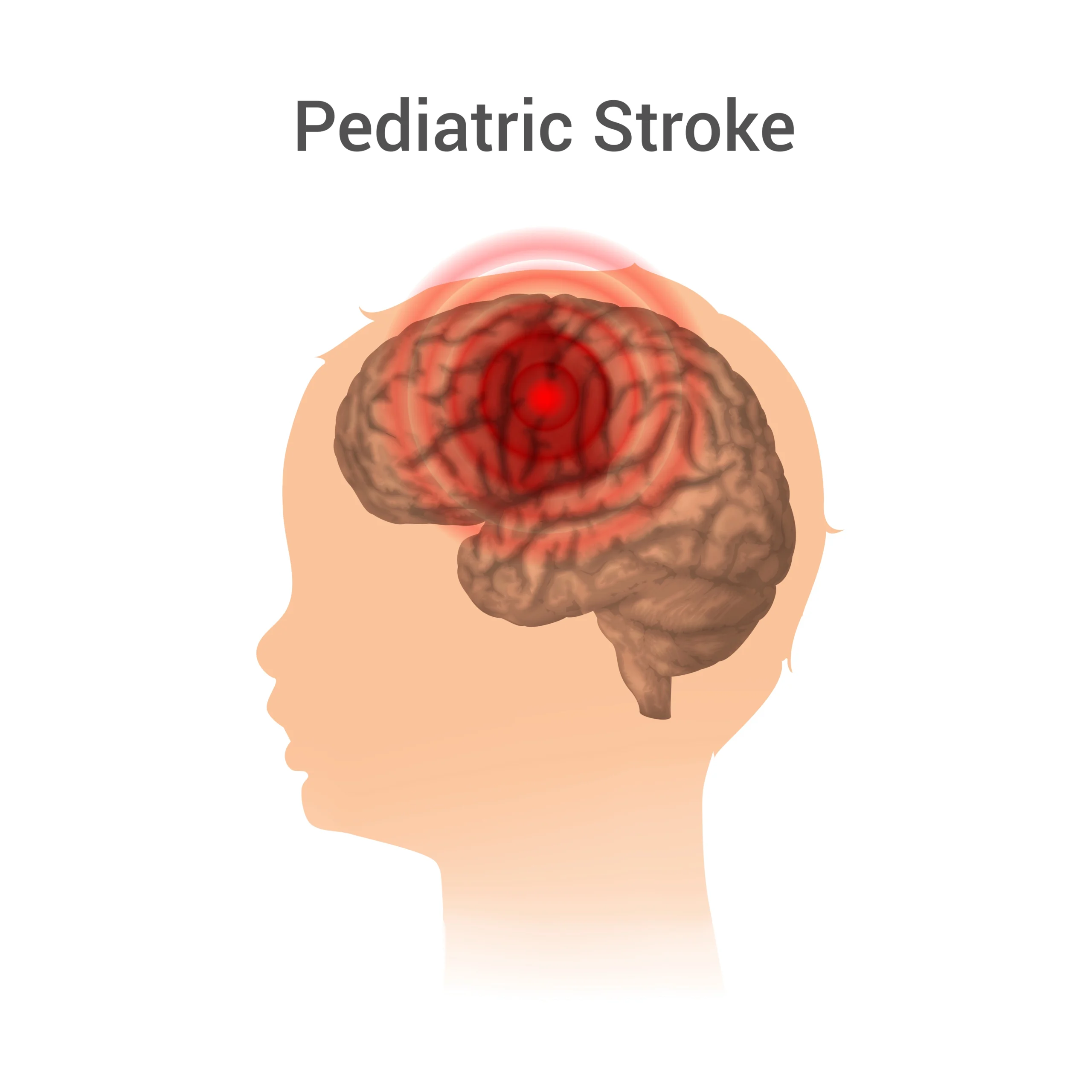 Paediatric Stroke Stroke In Children