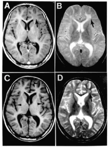 Subacute Sclerosing Panencephalitis