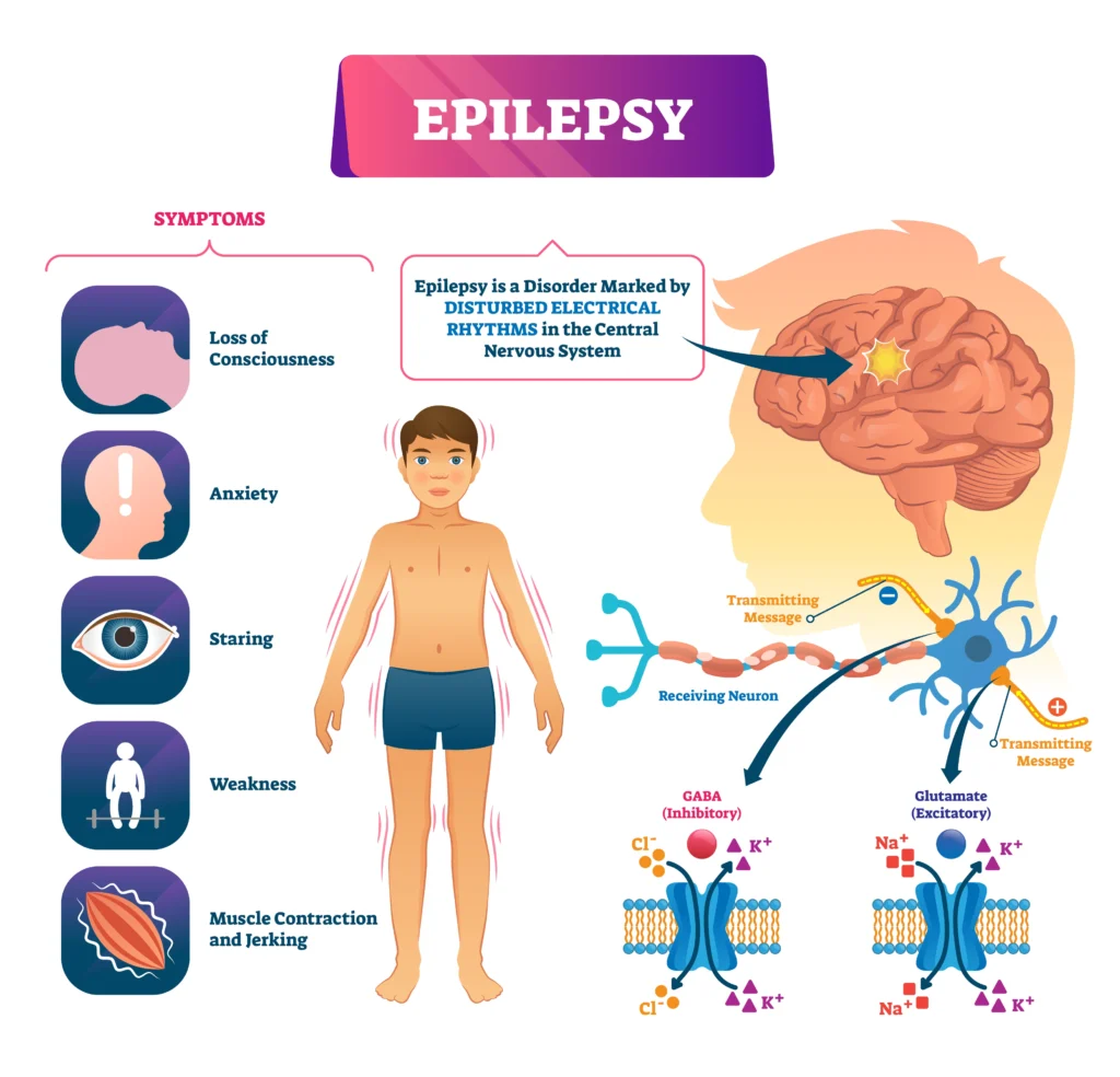 Epilepsy-dr.vievk jain
